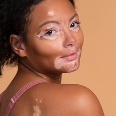 بهاق الوجه: أسبابه وأعراضه الشائعة وطرق علاجه!