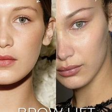 بوتكس رفع الحواجب