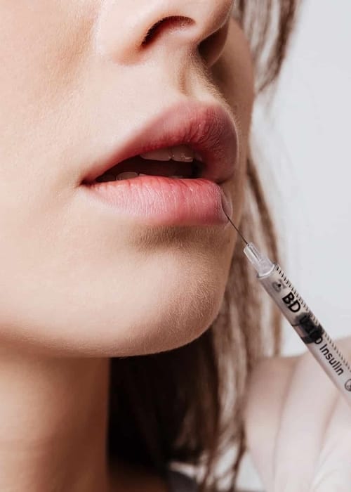 متى يزول تورم الشفايف بعد الفيلر؟