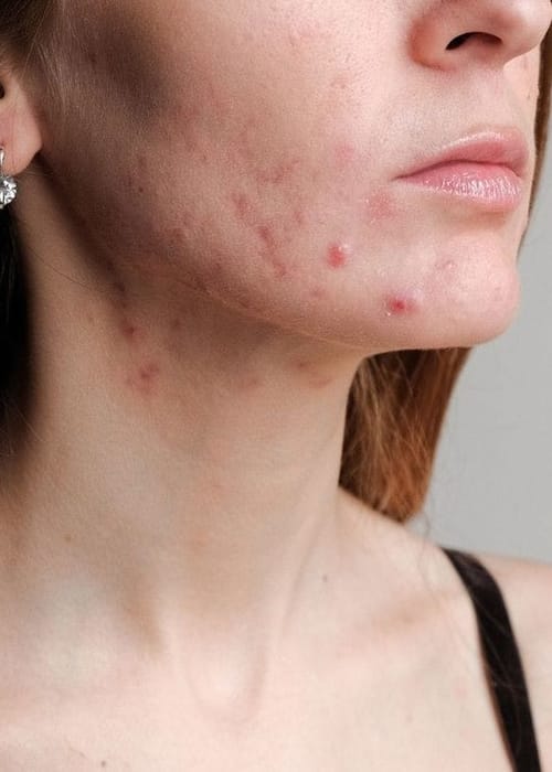 طريقة علاج الحبوب تحت الجلد في الوجه