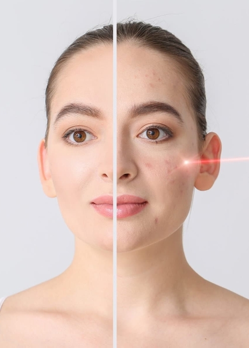 أفضل علاج ندبات الوجه نهائيا!