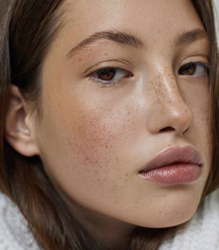 كلف الوجه: المشكلة الصامتة التي تؤرق صفاء البشرة