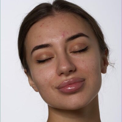 اليك كل المعلومات عن الحبوب الصغيرة في الجبهة... لا تتجاهلينها أبداً!